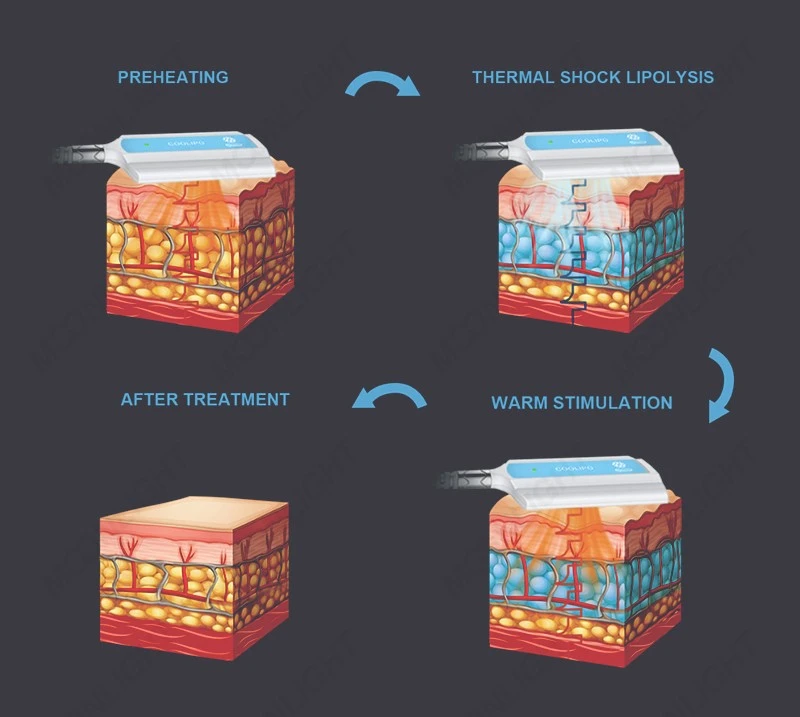 New Cool T-Shock PADS Cryolipolysis & Thermal Shock System price