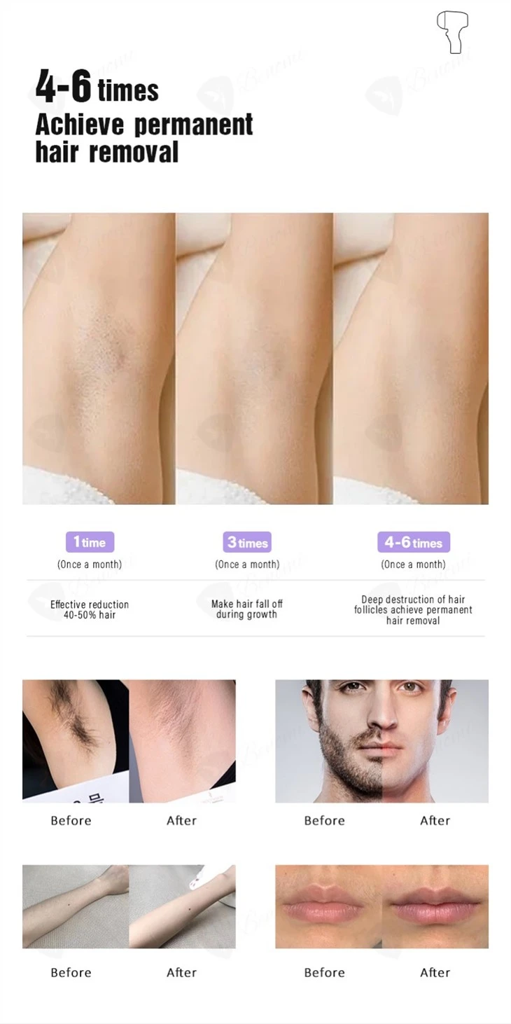 4 Wavelengths Hair Removal Laser Machine