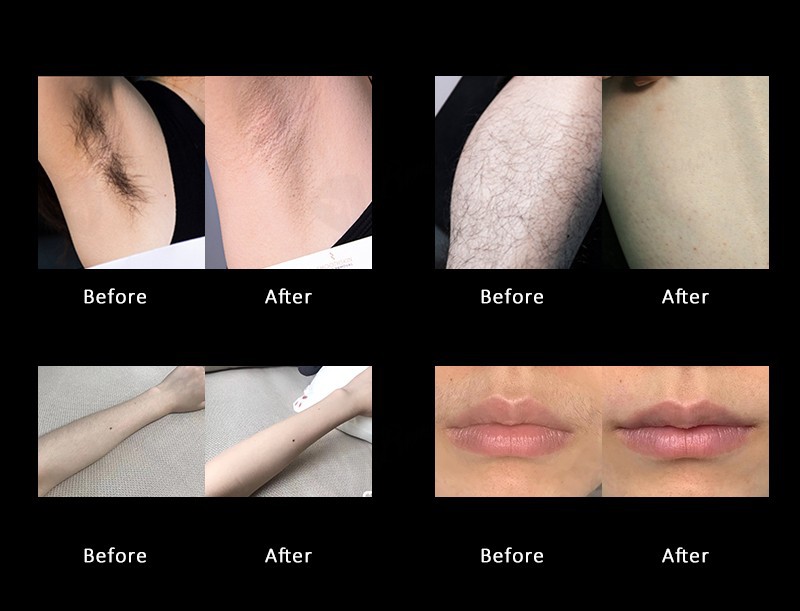 4 Wavelength Diode Laser Hair Removal Machine – Professional, Intelligent & Fully Customizable | MNLT Factory China high quality