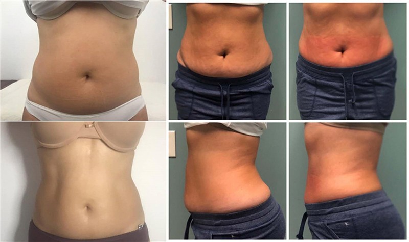 CroySkin Machine – Cryo-Thermal Sculpting & Rejuvenation System factory