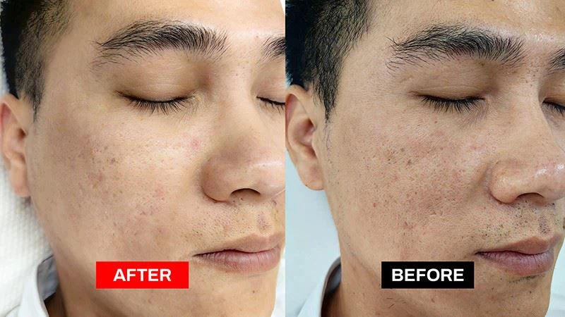 Crystallite Depth 8 – Advanced Gold RF Microneedling System factory